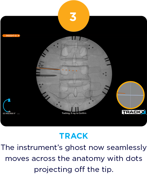 The instrument's ghost now seamlessly moves across the anatomy with dots projecting off the tip. 